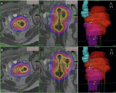 Intracavitary/Interstitial Applicator Plus Distal Parametrial Free Needle Interstitial Brachytherapy in Locally Advanced Cervical Cancer: A <mark class="highlighted">Dosimetric Study</mark>